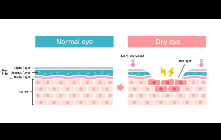 Graphical representation of the cross section comparison of a normal eye to that of a dry eye. The normal eye on the left side shows all cell layers in good condition, where as the dry eye on the right shows a gap in the tear film and resulting dry spot.
