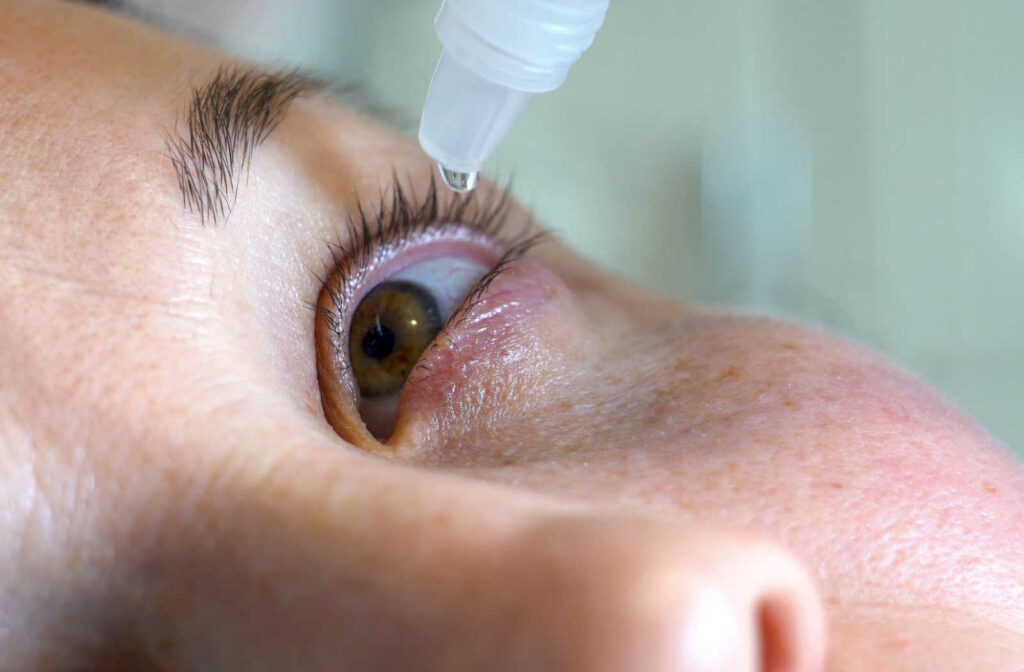 Close-up of an eye of a woman treating blepharitis with antibiotic drops. BlephEx treatment is an option that can relieve symptoms by removing the blockages that lead to dry eyes for longer-lasting relief